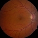 Plaquenil Toxicity